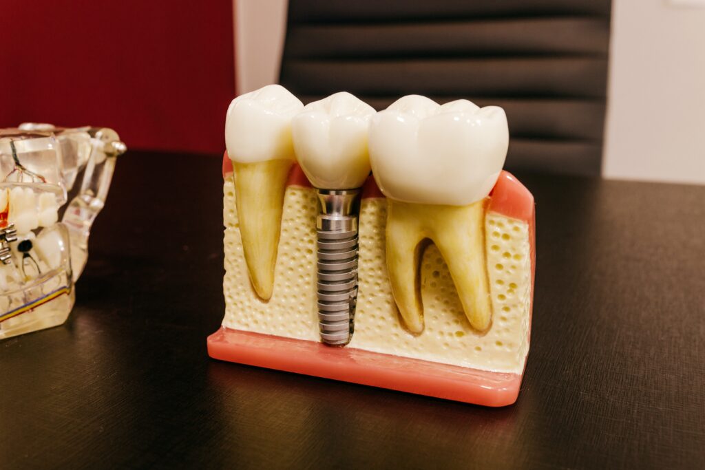 Dental Implants: Purpose, Cost, and Expectations