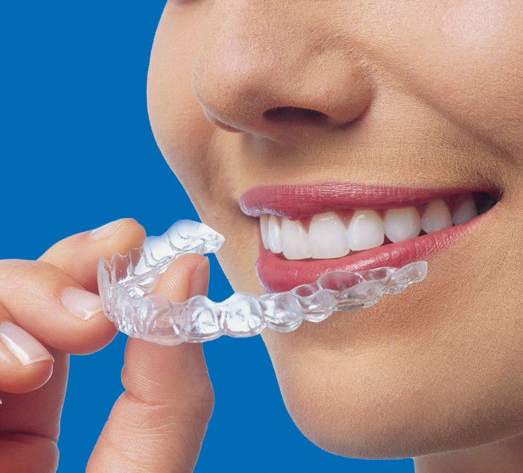 Top 20 Things to Know Before An Invisalign Treatment | Locust Family ...