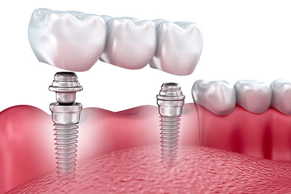 Implant-Retained Bridges vs. Dentures