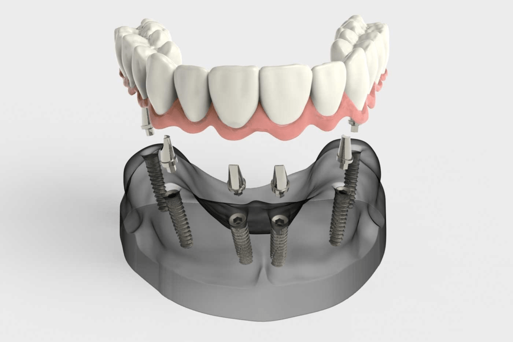 ImplantSupported Prosthesis Types & Benefits Locust Family Dentistry