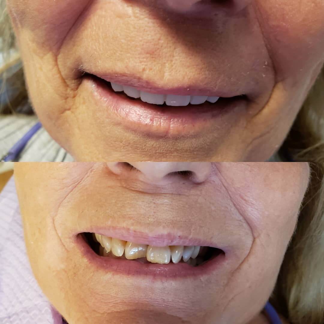 Porcelain dental veneers in Locust, NC before and after