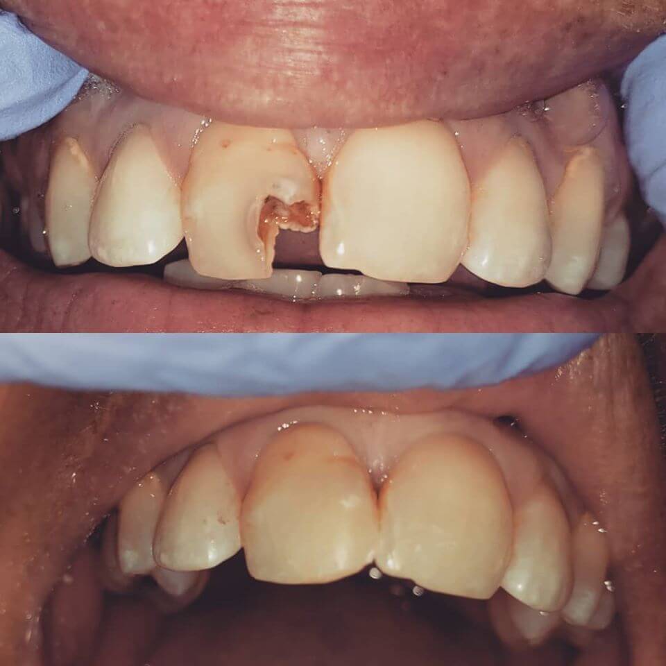 Fillings in Locust, NC before and after