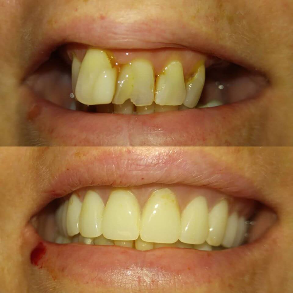 Crowns in Locust, NC before and after