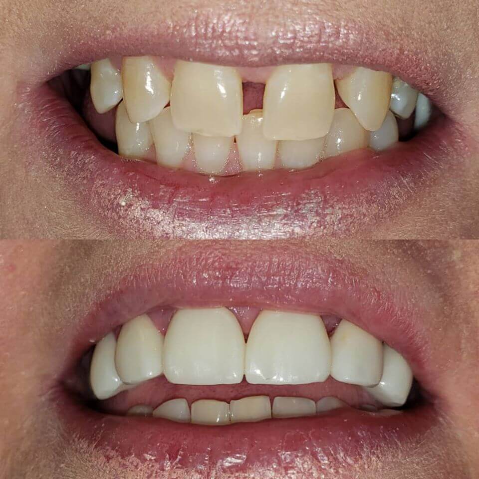 Dental crowns and bridge in Locust, NC before and after