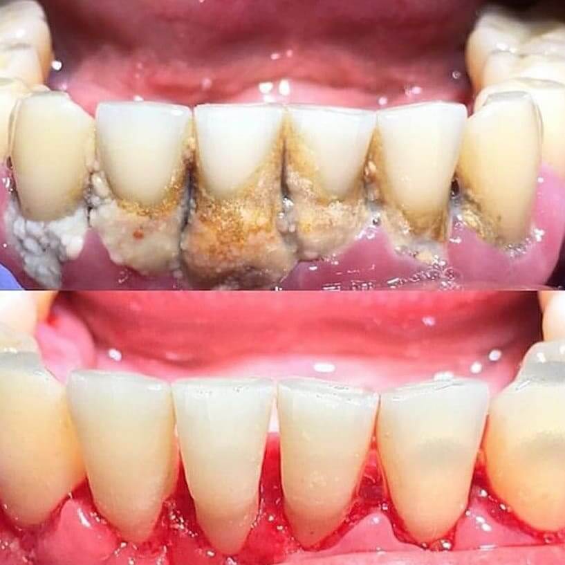 Tartar removal in Locust, NC before and after