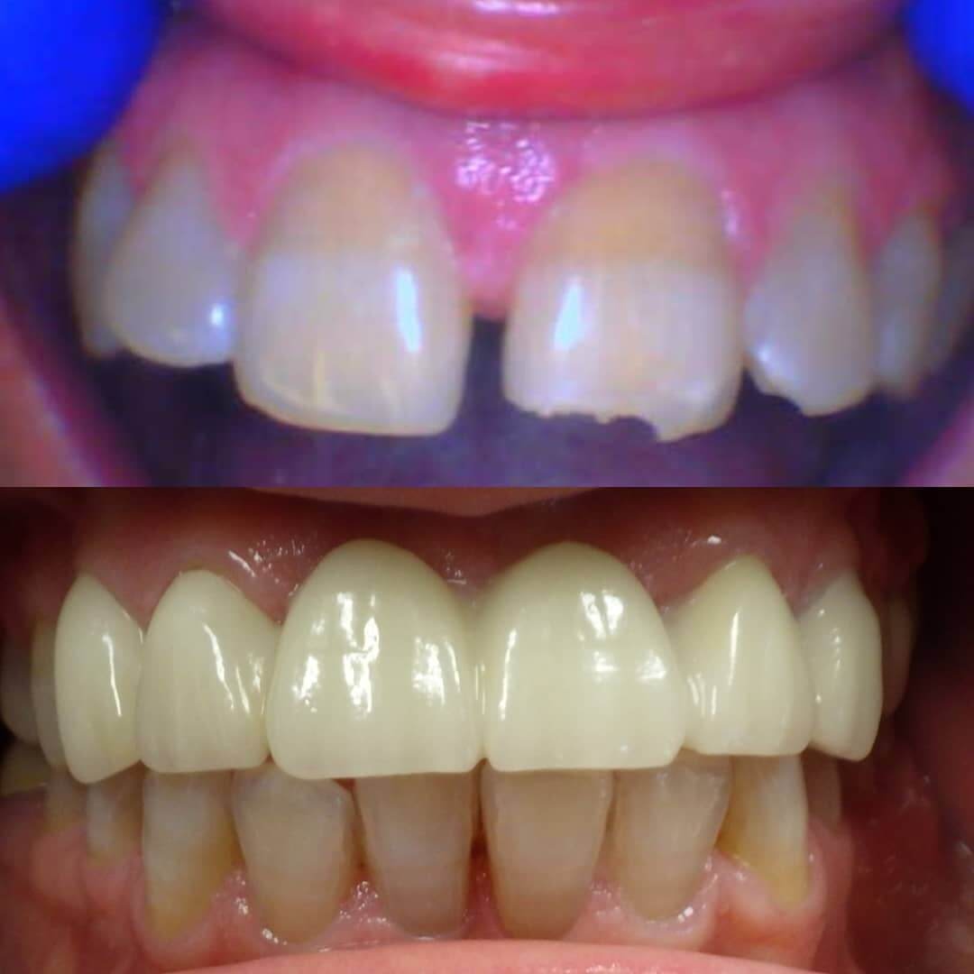 Crowns in Locust, NC before and after