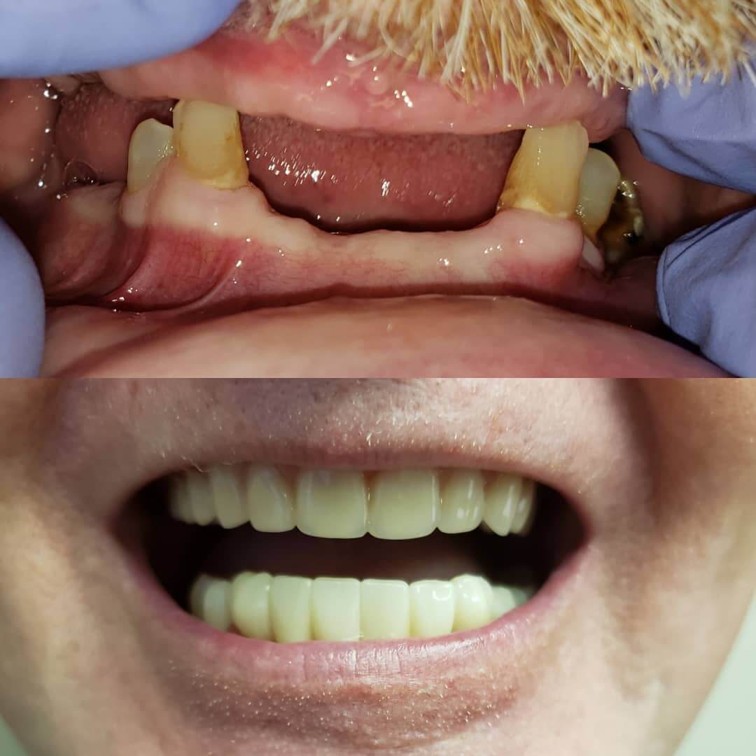 Dental bridge in Locust, NC before and after