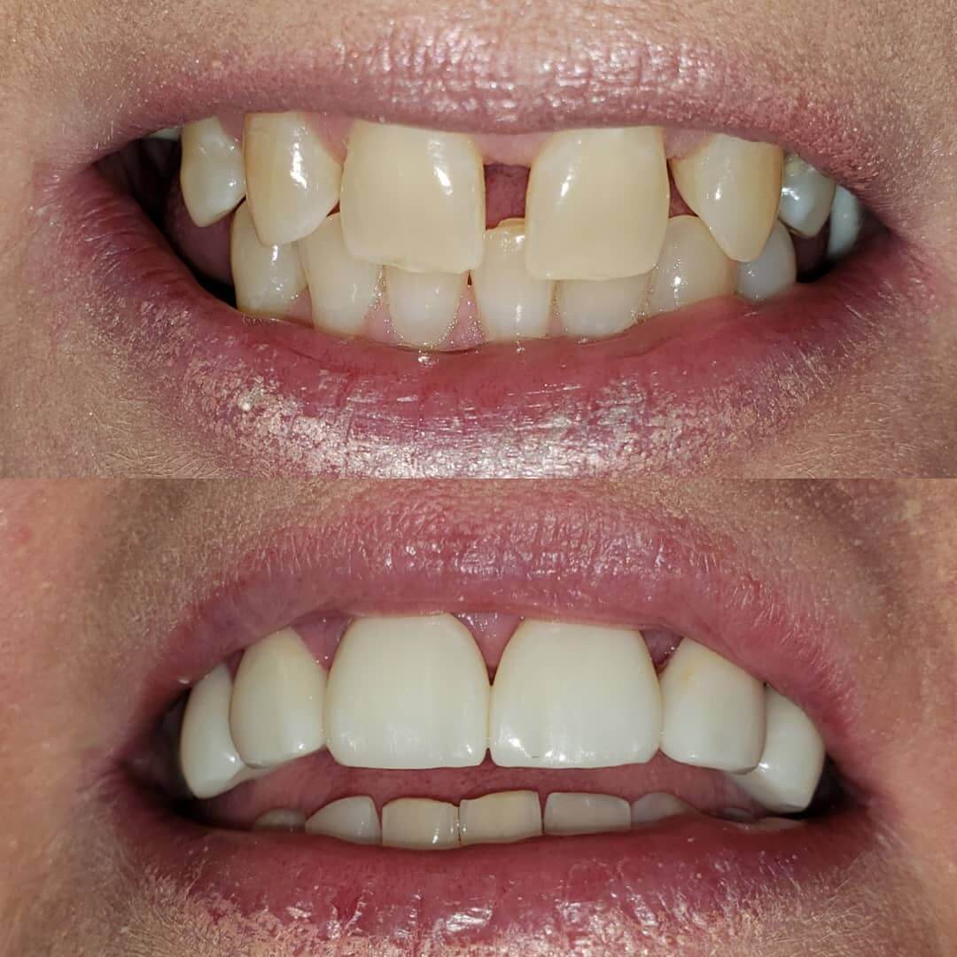 Porcelain dental veneers in Locust, NC before and after