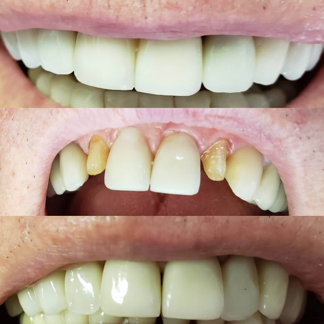 Crowns in Locust, NC before and after