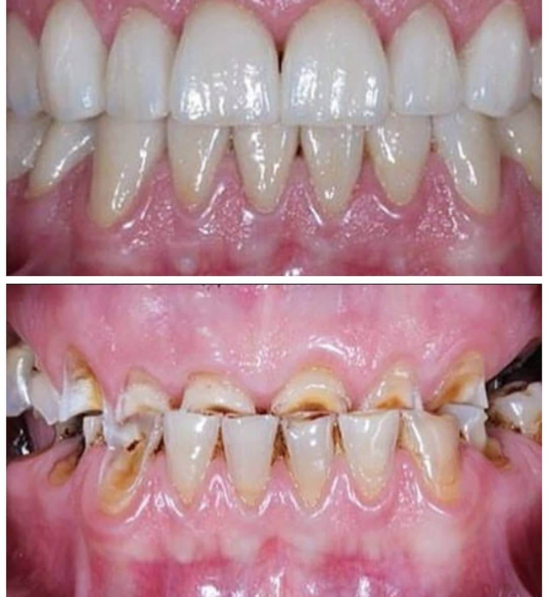 Dental implants in Locust, NC before and after