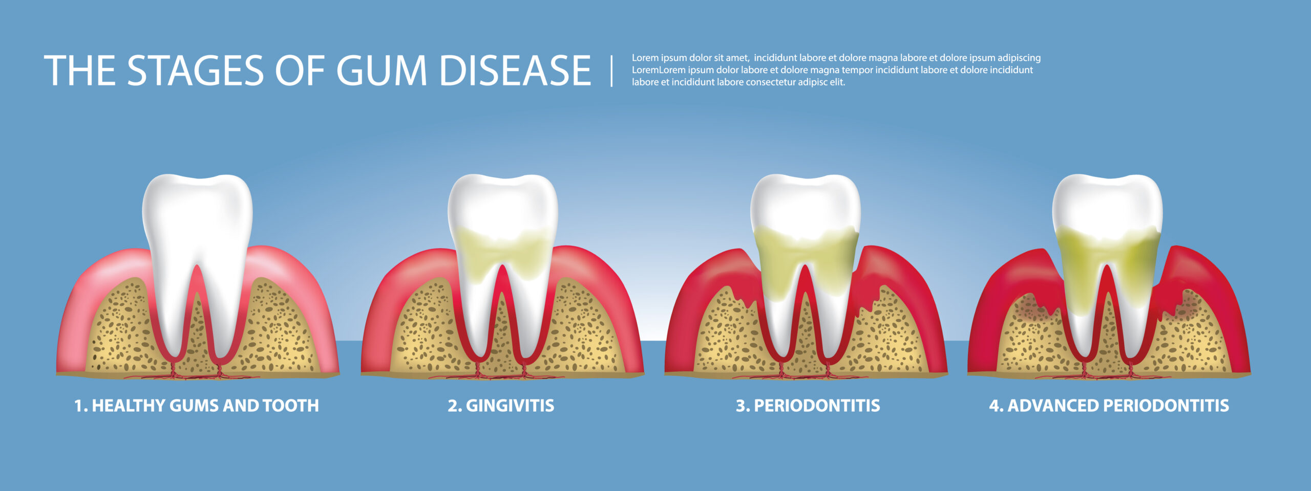 The Dangers of Tooth Decay and Gum Disease