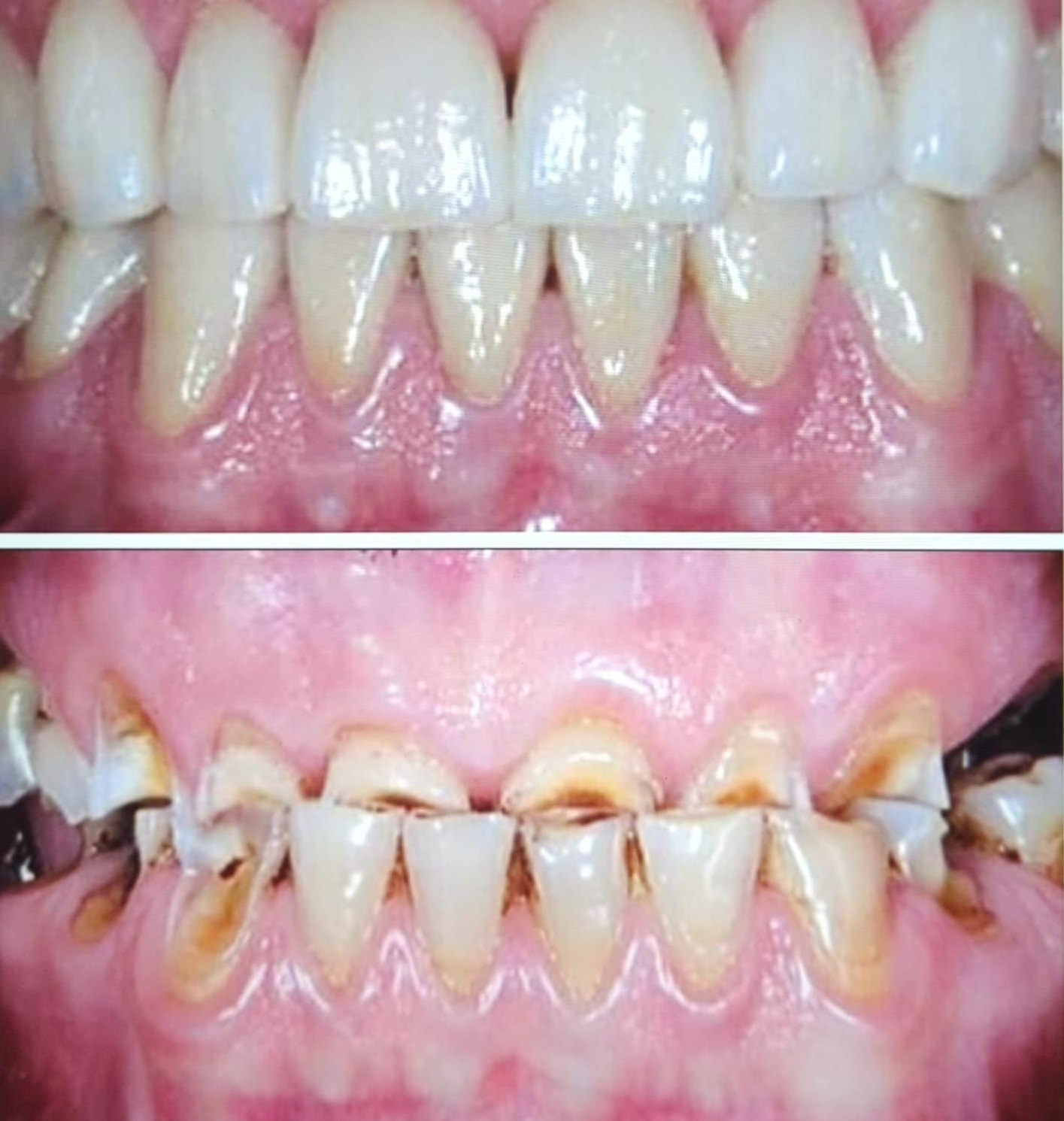 Transform Your Smile with Full Mouth Rehabilitation in Locust, NC