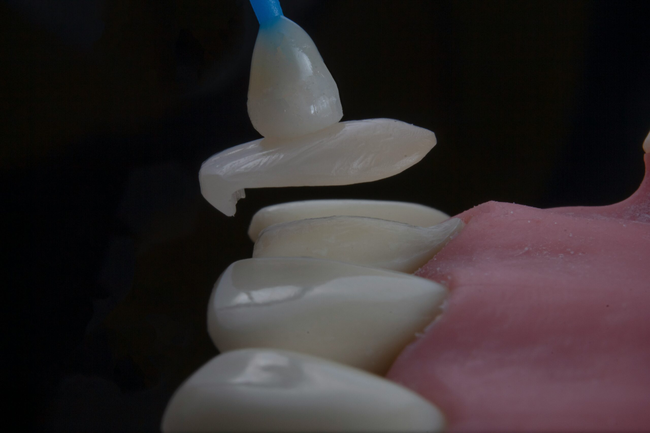 Veneers vs. Crowns: Which One Is Right For You?