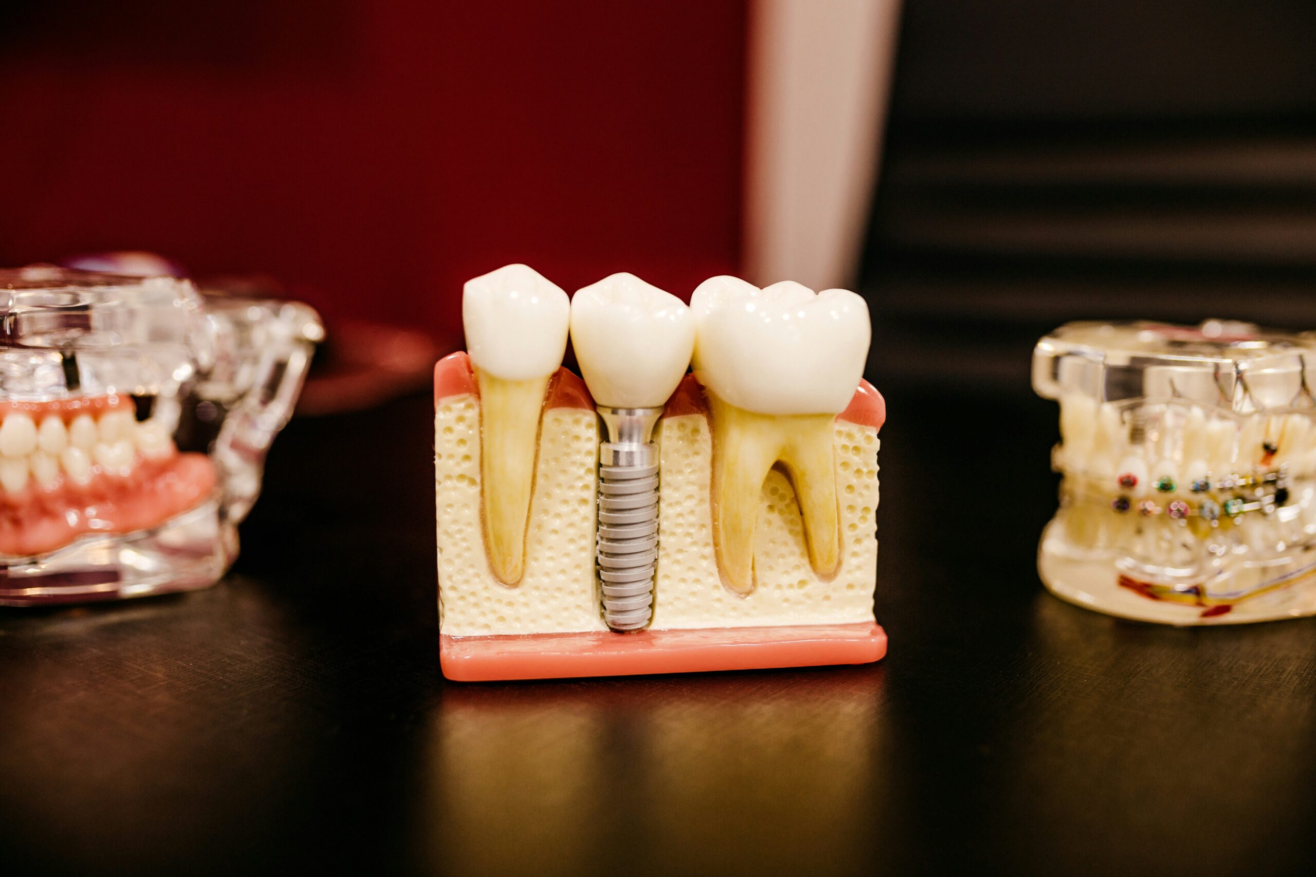 Do Dental Implants Hurt?