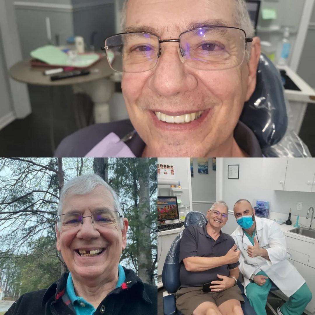 Before and after dental implants from a trusted dentist near me in Mount Pleasant, NC.